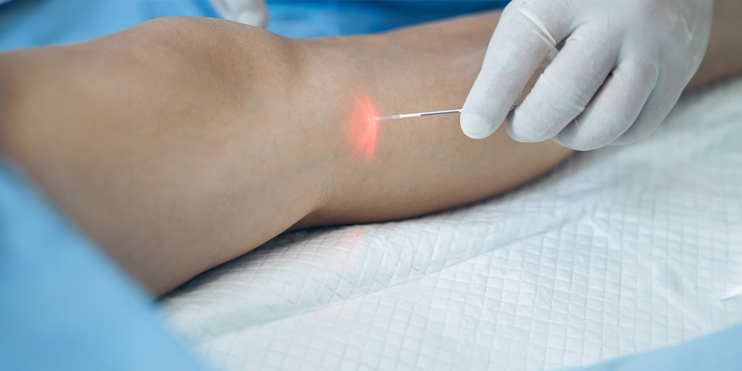 Phlebologie Passau – Endovenöse Lasertherapie EVLT Venentherapie