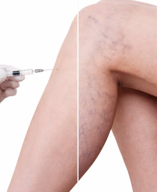 Ästhetische Venenbehandlung Passau – Mikrosklerotherapie Besenreiser veröden